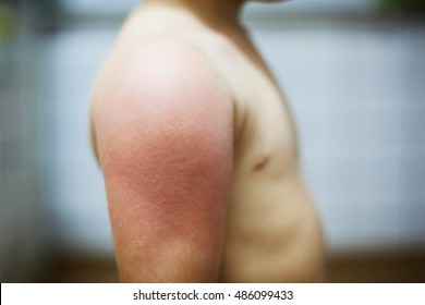 Child With Swoolen Hand Having Allergic Reaction To Vaccine