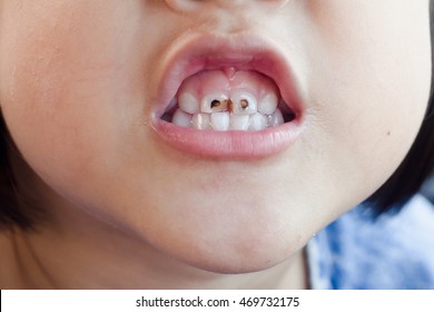 Child Tooth Decay.
Smiling Children.
