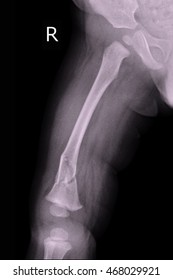 Child Xray Show Fracture Right Femur 