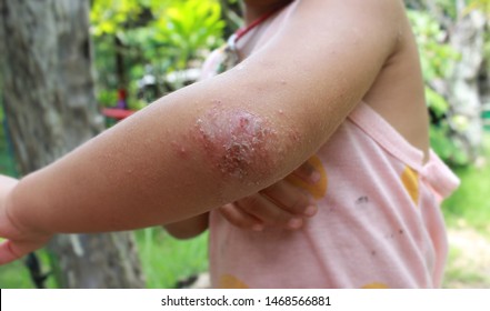 Children With Eczama Come From An Itch That Is Allergic To Air​. Closeup​ Eczama​ Child​ Skin.