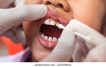 Children Girl Receive Fluoride Medicine And Dental Examination In The Mouth By A Dentist.