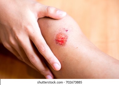 Children Injury - Painful Knee Wound Accident. Close Up On An Bleeding Scraped Child Knee After Run Accident. Closeup.