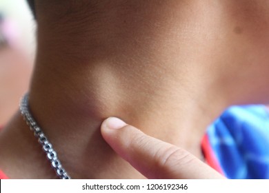 Children Neck Lymph Node Inflammation (lymphadenitis) Is Disease Of Is An Infection