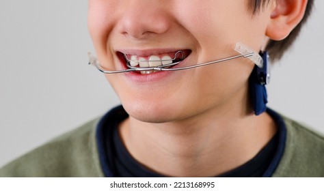 Children Tooth Care And Hygiene. Portrait Of A Teenager Boy With Diastema Overbite Teeth Missing Gap Wearing Orthodontic Appliance Treatment. Dental Braces With Child Concept.