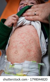 Children viral disease or allergies. Red measles rash on baby. Child with viral children disease infection. Concept of viral baby disease and vaccination.