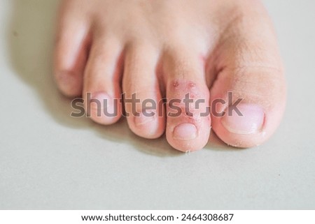 Children's feet with blisters on the toes