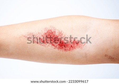 Children's hand burn. Children's hand with a burnt wound on a white background.Close up