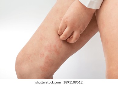 Children's hands scratching acute atopic dermatitis. Itchy skin on the legs is a dermatological disease of the skin in children. Legs of a teenager with severe atopic eczema.