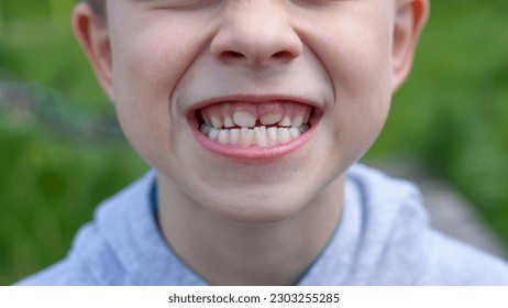 Children's teeth. The molar grows in the second row. Anomalies of tooth growth.