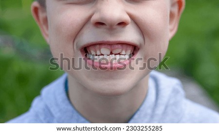 Children's teeth. The molar grows in the second row. Anomalies of tooth growth.