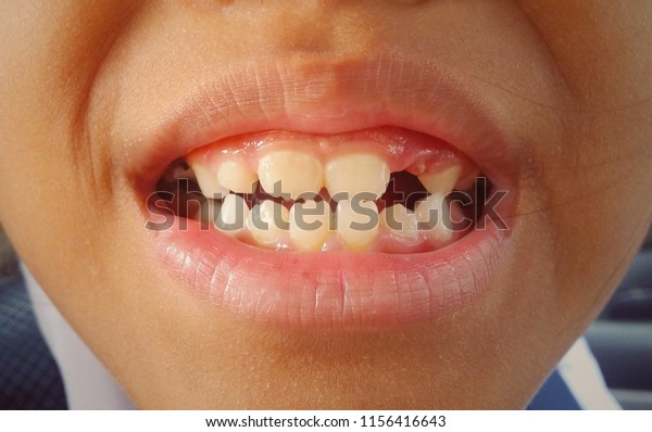 Childrens Teeth When Grown Will Fall Stock Photo (Edit Now) 1156416643