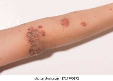 Child's Arm With Impetigo Skin Condition