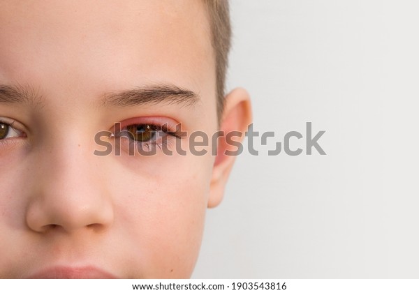 Childs Eye Stye Ophthalmic Disease Hordeolum Stock Photo Edit Now