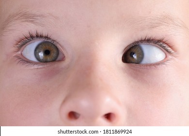 Child's Face With Squint And Freckles On Nose. Strabismus In Children Causes And Treatment Concept