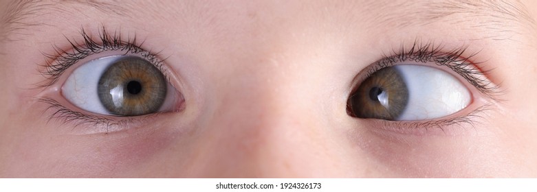 Child's Face With Squint And Freckles On Nose. Strabismus In Children Causes And Treatment Concept