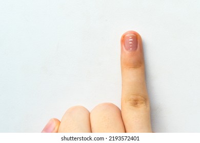 Child's Finger With A White Spot On The Nail