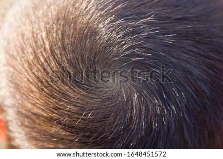 child's hair that normally goes to the top of the head, as the hair grows counterclockwise.