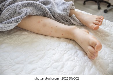 Child's legs with a lot of hair, bruises, with many red spot, wounds from scratches and scars from insect bite, mosquitos and fleas. Kids legs are on a bed coverlet and the nails are uncut.  - Shutterstock ID 2025306002