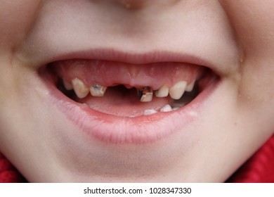 Bad Teeth Images, Stock Photos & Vectors | Shutterstock