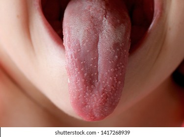 The Child's Tongue With Scarlet Fever Blistered. Infectious Disease Of The Child