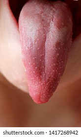 The Child's Tongue With Scarlet Fever Blistered. Infectious Disease Of The Child