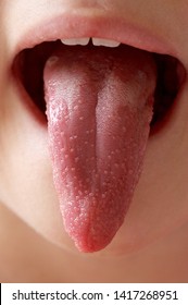 The Child's Tongue With Scarlet Fever Blistered. Infectious Disease Of The Child