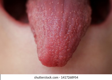 The Child's Tongue With Scarlet Fever Blistered. Infectious Disease Of The Child