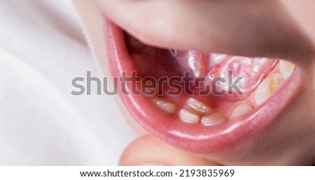 A child's tooth grows second next to the milk teeth. Formation of the jaw and permanent teeth in children. Removal of milk teeth.