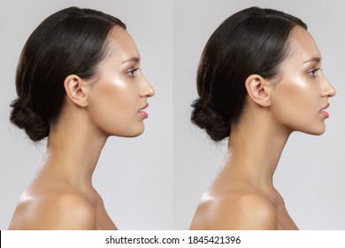 chin lift. photo before after