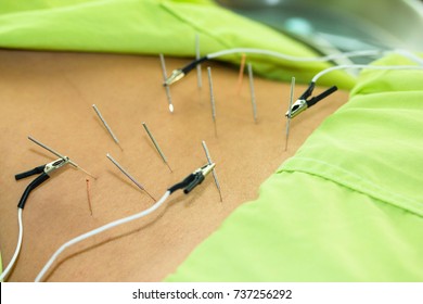 Chinese Acupuncture with Electrical stimulator on back