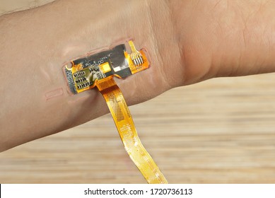 The Chip Is Mounted Under The Skin. Chips Embedding Concept. Chip On Wrist Close Up. Hand On Scars After Laser Surgery.