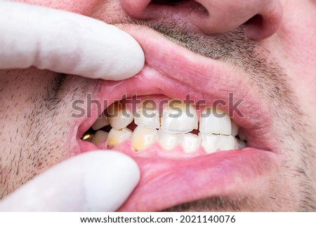 Chipped and cracked tooth enamel, enamel hypoplasia, malocclusion. Bad teeth of a middle-aged man.  Negligent attitude towards your health, concept.