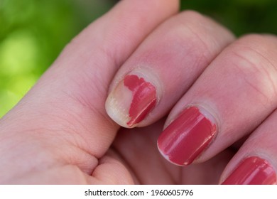 Chipped Nail Polish. Woman's Fingers With Chipped Nail.