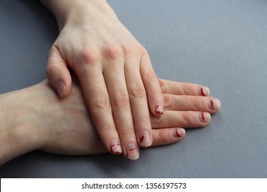 Chipped, Stratified Nails. Nails After Gel Polish. The Concept Of Nails Before The Manicure.untidy Hands On A Gray Background.the View From The Top.