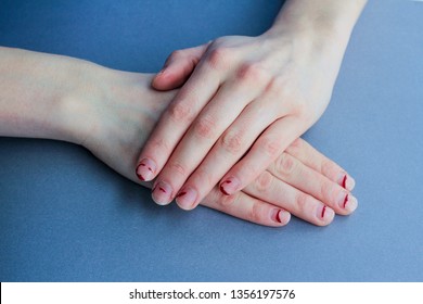 Chipped, Stratified Nails. Nails After Gel Polish. The Concept Of Nails Before The Manicure.untidy Hands On A Blue Background.the View From The Top.