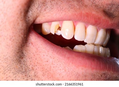 A chipped tooth is a tooth that has broken. A small or large piece may have been knocked off through a fall, sports injury, or other trauma to the mouth, including biting something hard.  - Shutterstock ID 2166351961