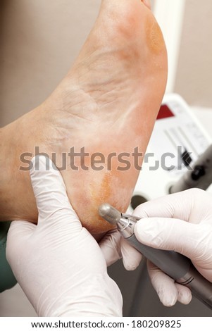 A chiropodist taking care of woman's foot - remove dry skin with a Grinder
