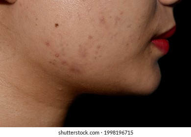 Chloasma Or Melasma , Black Spots And Acne Scars On Face Of Asian Young Woman.  Closeup View.