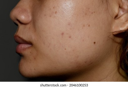 Chloasma Or Melasma , Black Spots And Acne Scars On Face Of Asian Young Woman.