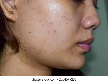 Chloasma Or Melasma , Black Spots And Acne Scars In Asian Young Woman.