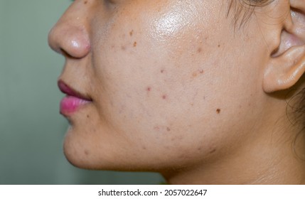 Chloasma Or Melasma , Black Spots And Acne Scars In Asian Young Woman. 