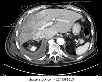 Cholangiocarcinoma - Intrahepatic Duct Dilatation, Liver Capsule Retraction