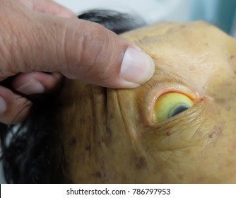 Cholestatic Jaundice Presented With Yellowish Discoloration Of Sclera And Skin In Pancreatic Carcinoma Patient.