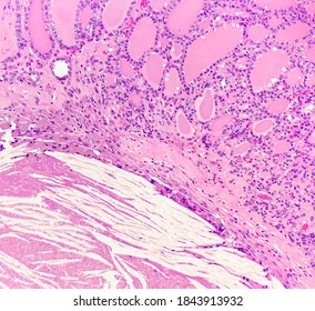 Cholesterol Cleft (left Lower) And Nodular Goiter (right Upper) In Thyroid Gland, Magnification 200x, Photo Under Microscope