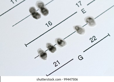 Chromosomes 21, Trisomy 21, Down Syndrome