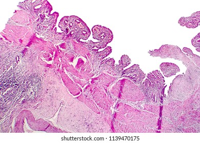 512 Chronic Cholecystitis Images, Stock Photos & Vectors | Shutterstock