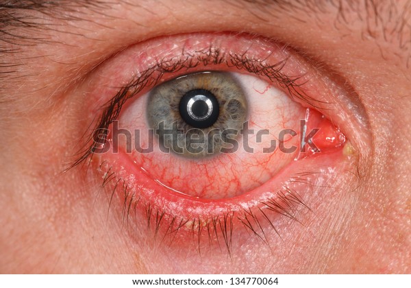 Chronic Conjunctivitis Eye Red Iris Pus Stock Photo (Edit Now) 134770064