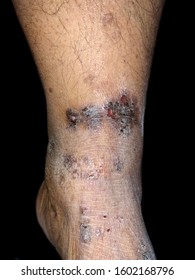 Chronic Eczema Or Atopic Dermatitis At Leg Of Southeast Asian, Myanmar Adult Woman. It Is Condition Where Patches Of Skin Become Inflamed, Itchy, Red, Cracked, And Rough. Isolated On Black Background.