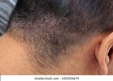 A (Chronic Inflammation On The Skin) Appears As A Red, Itchy And Scaly Dandruff On The Head.