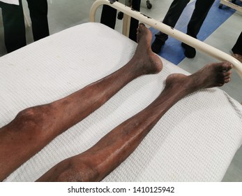 Chronic Limb Ischemia Of Bilateral Lower Limb Showing Signs Of Muscle Lost, Shiny Skin, Loss Of Hair And Brittle Nails.